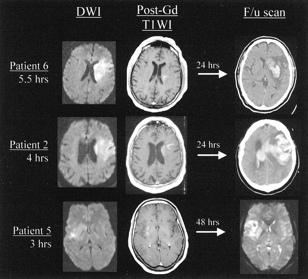 Hemorrhagic Stroke MRI Findings: What Your Scan Reveals