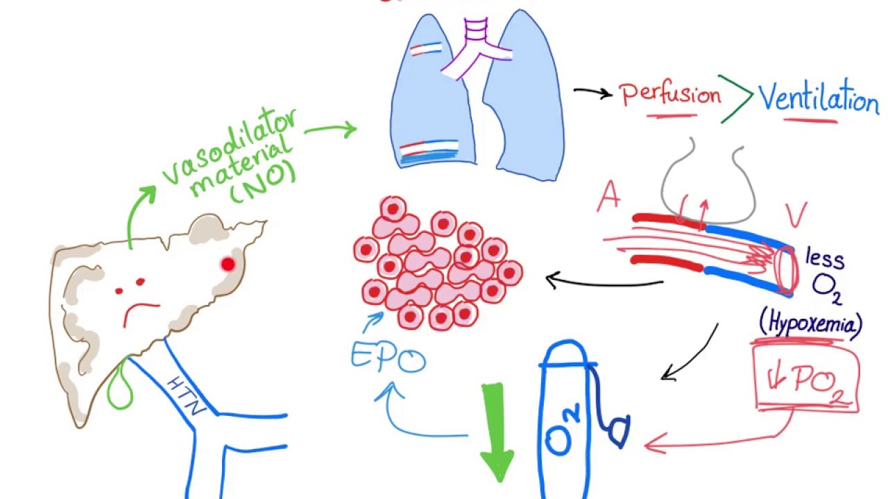 Understanding Hepatopulmonary Syndrome Pathophysiology: A Friendly Deep‑Dive