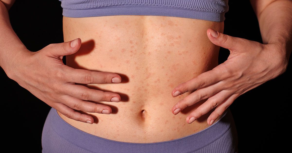 Understanding why hives that come and go daily appear