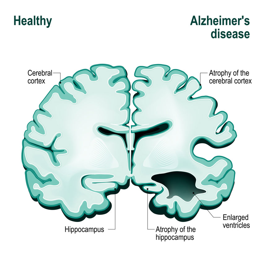 Understanding How Alzheimer’s Spreads in the Brain
