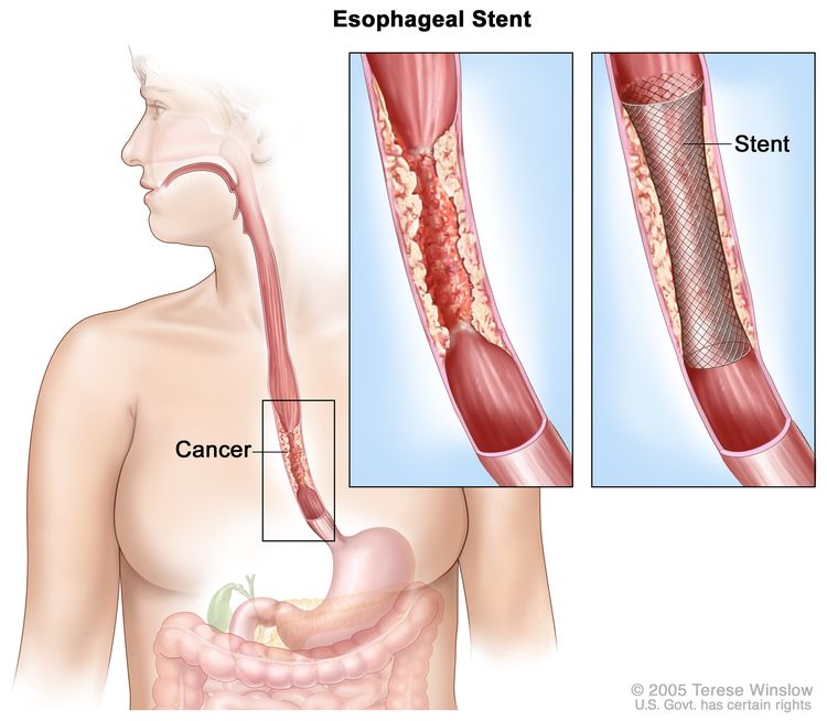 How Long Can You Live With Esophageal Cancer Without Treatment?