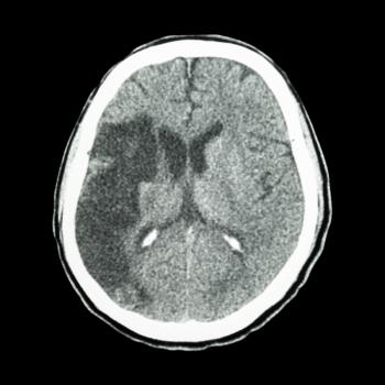 How Long Will a Stroke Show Up on a CT Scan for You?