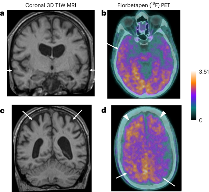 Iatrogenic Alzheimer’s Disease in Recipients of Cadaveric Pituitary‑Derived Growth Hormone