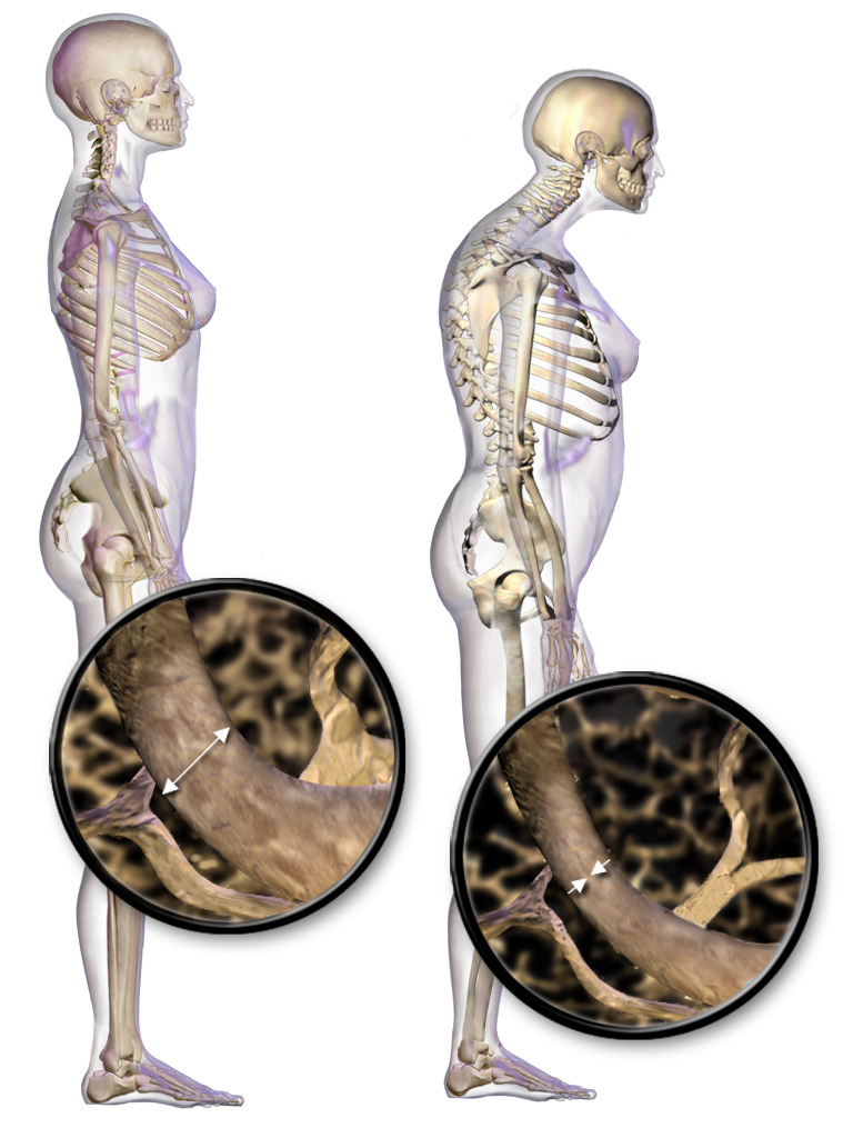 Is Osteoporosis a Terminal Illness? Truth, Risks & Care