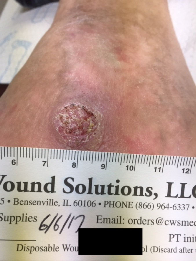 Is Verrucous Carcinoma Dangerous? Get the Facts