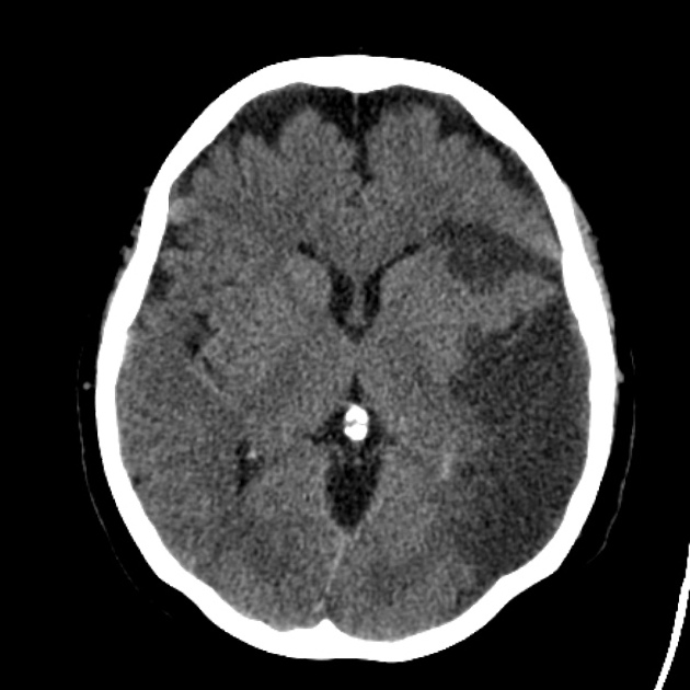 Ischemic Stroke CT Scan: What You Really Need to Know