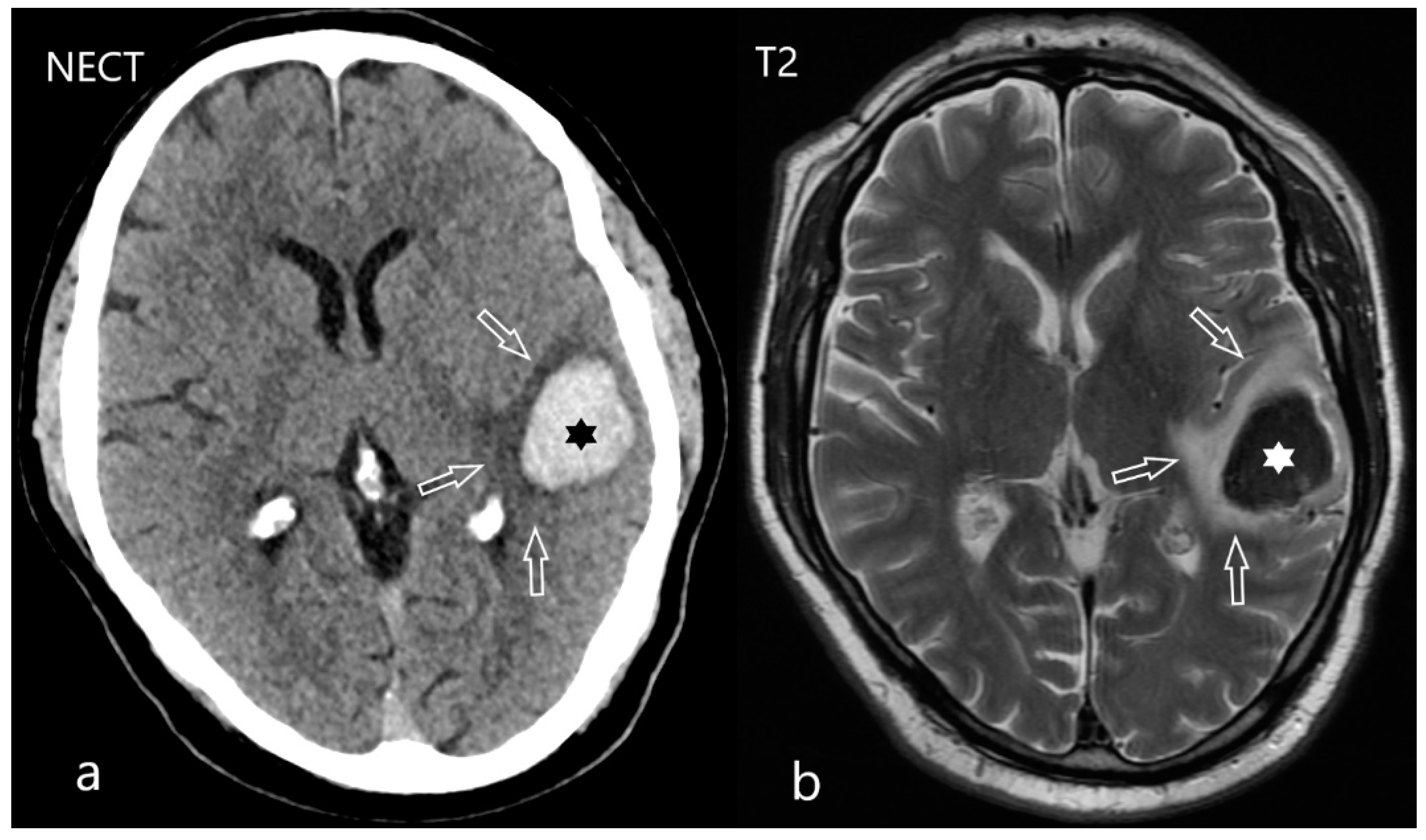 Ischemic Stroke MRI Findings: Your Quick, Clear Guide
