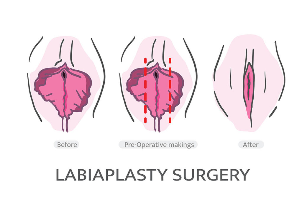 Labiaplasty Cost Guide: Prices, Risks & What to Expect