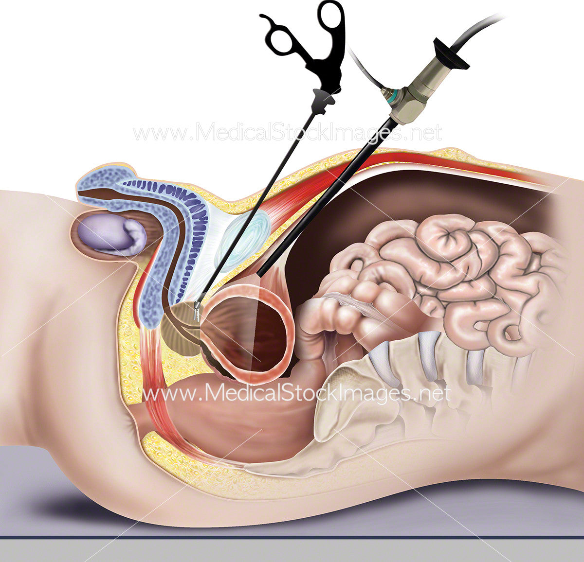 Laparoscopic Surgery for Prostate Enlargement: Key Facts