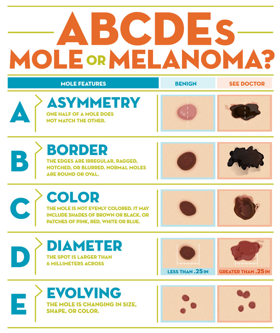 Melanoma detection ABCDE – Simple Guide for You