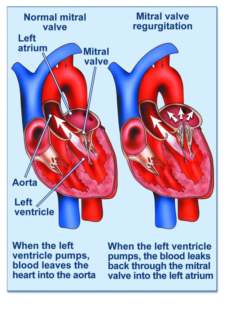 Mitral Valve Regurgitation Symptoms – How to Spot Them