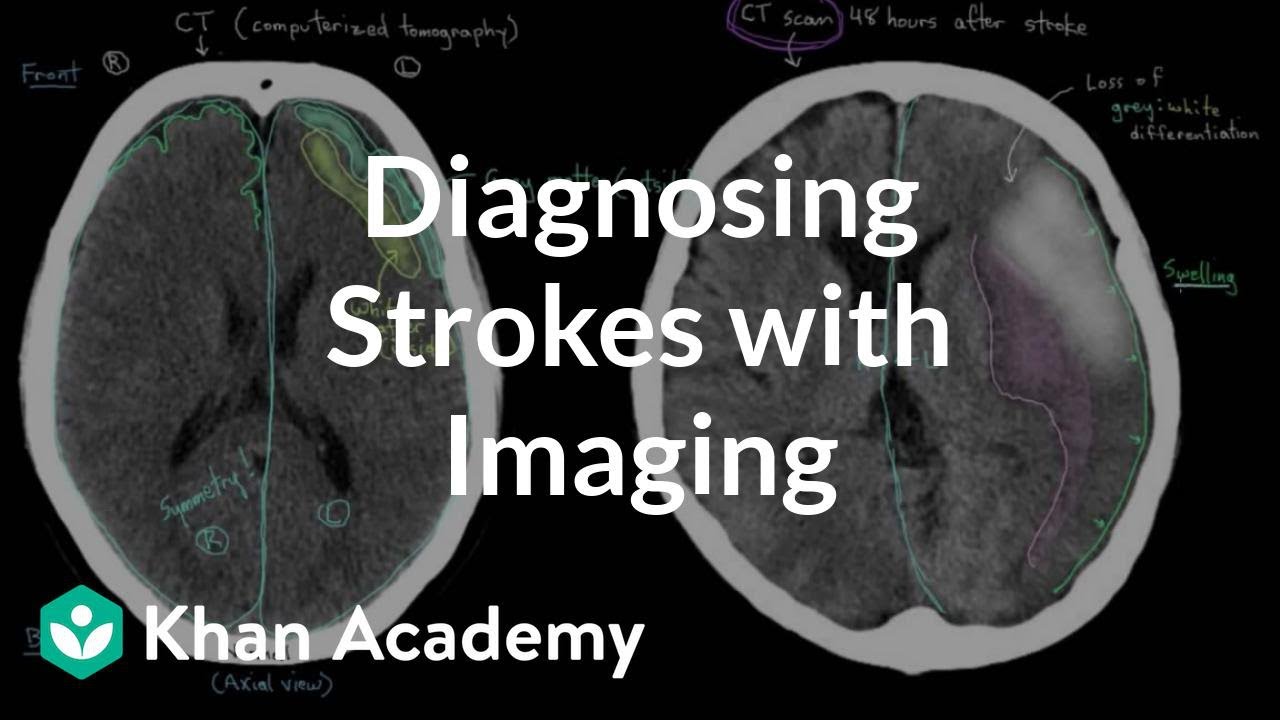 MRI or CT Scan for Stroke – Which Test Is Right?