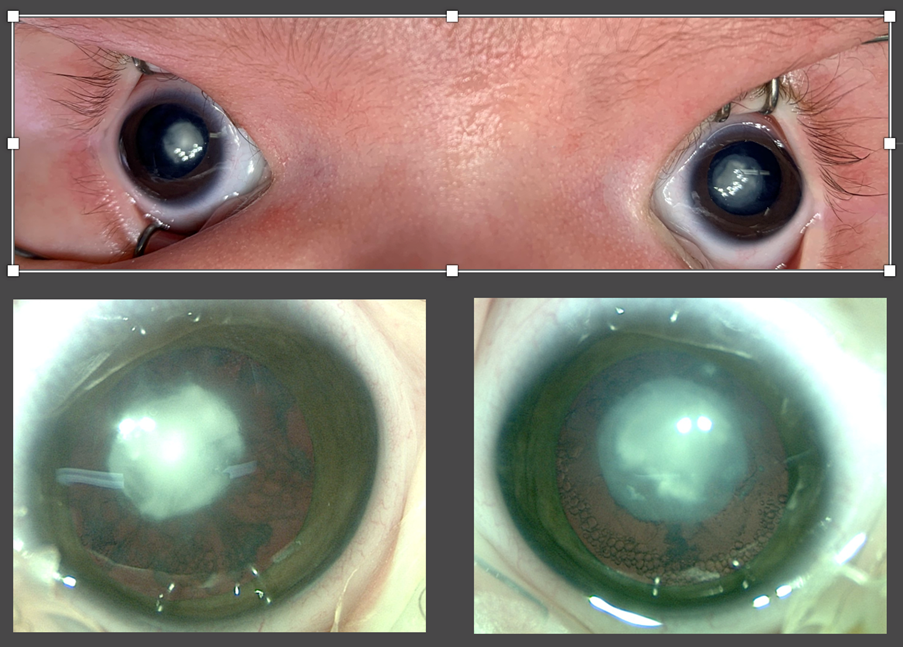 Pediatric Cataract Treatment: What Parents Need to Know