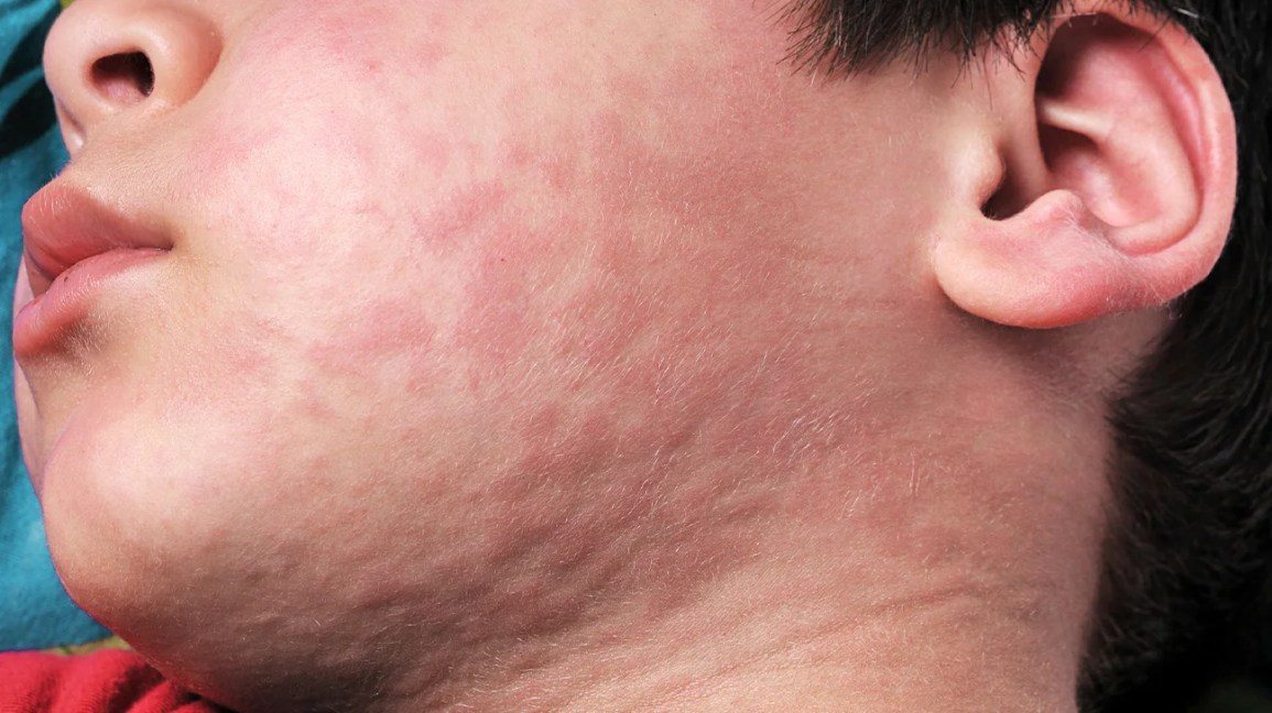 Pictures of Hives on Face: Identify, Causes & Care