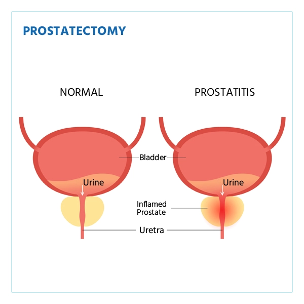 Prostatectomy Indications: When Surgery Is Needed