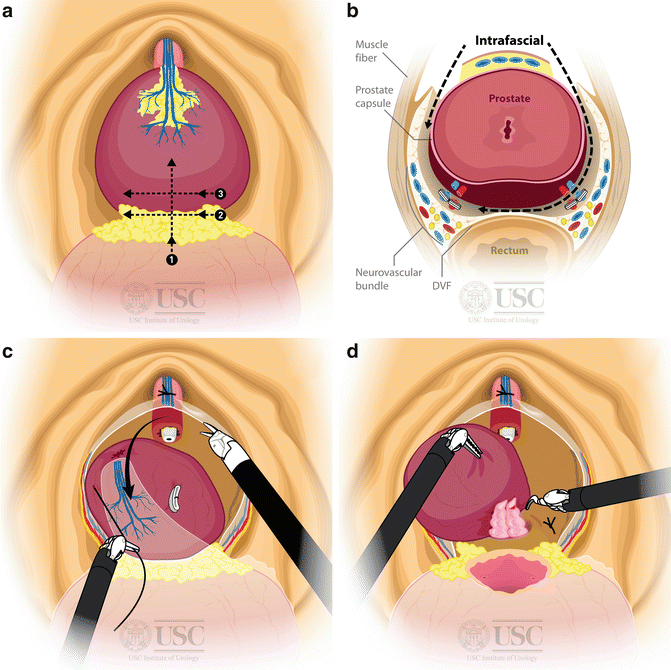 Robotic Simple Prostatectomy Side Effects Explained