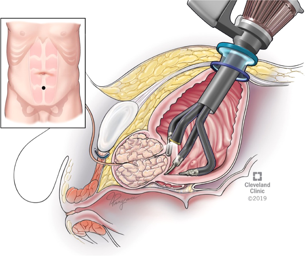 Robotic Simple Prostatectomy vs TURP: Which Is Right?
