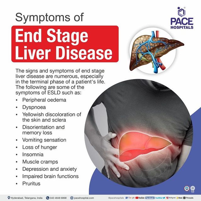 Signs of Death from Liver Failure: What to Watch For