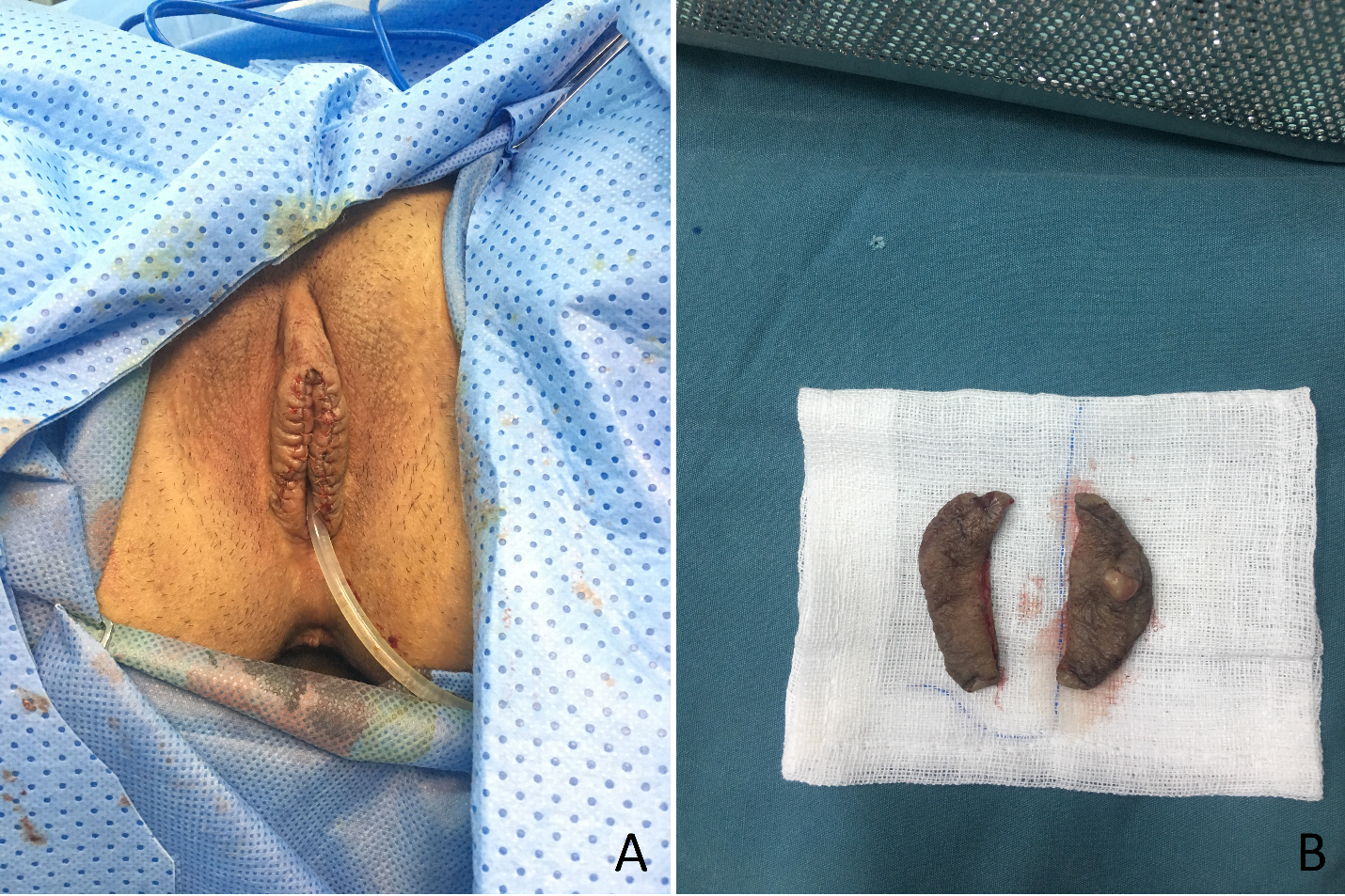 Signs of Infection After Labiaplasty: What to Watch For