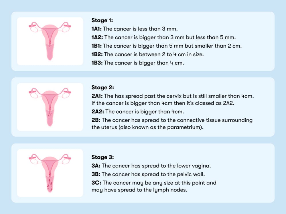 Stage 1 Cervical Cancer Survival Rate – Essentials