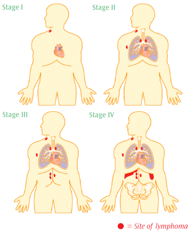 Stage 2 Lymphoma Symptoms – What You Need to Know