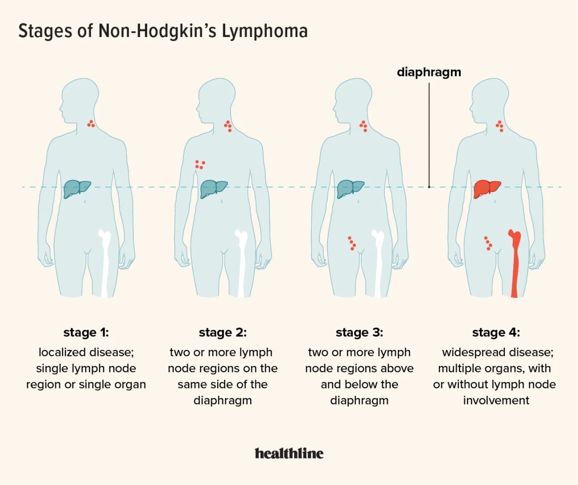 Stage 3 Lymphoma Survival Rate: What the Numbers Mean