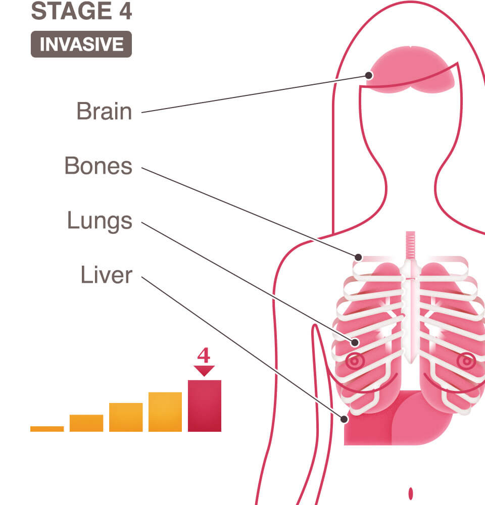 Stage 4 Cancer Life Expectancy With Treatment