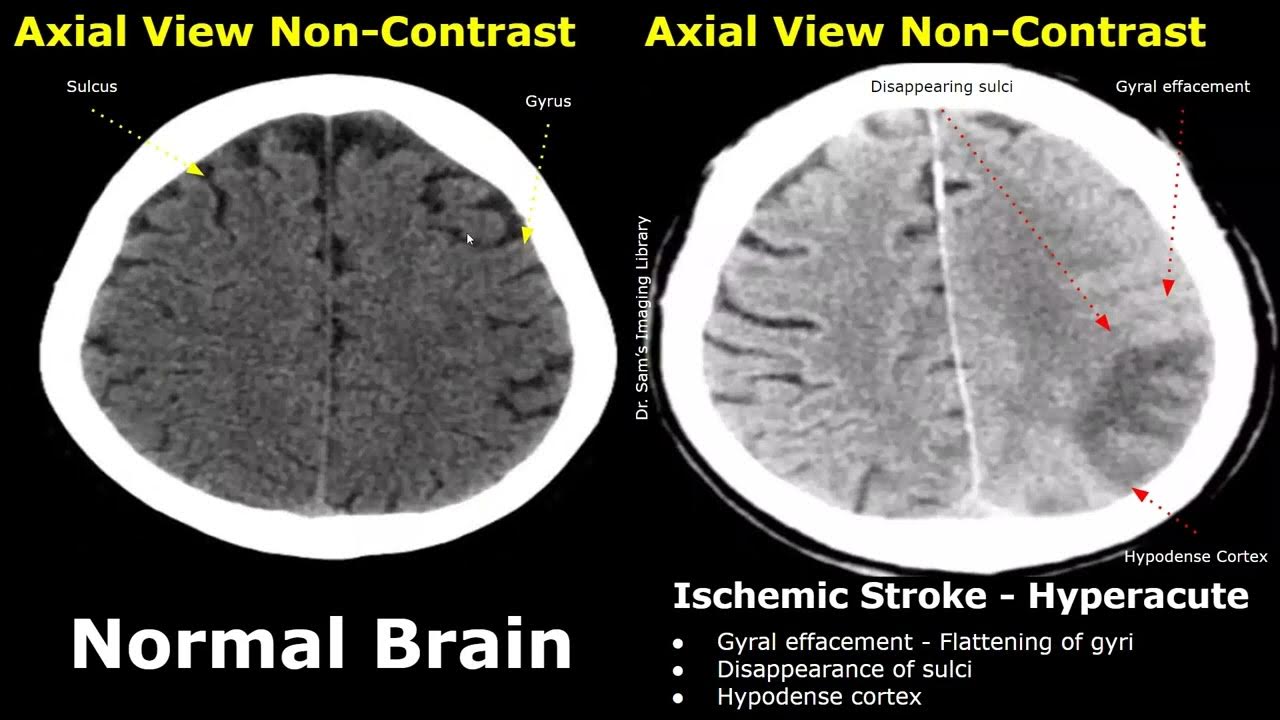 Stroke CT Scan Interpretation: A Practical Guide