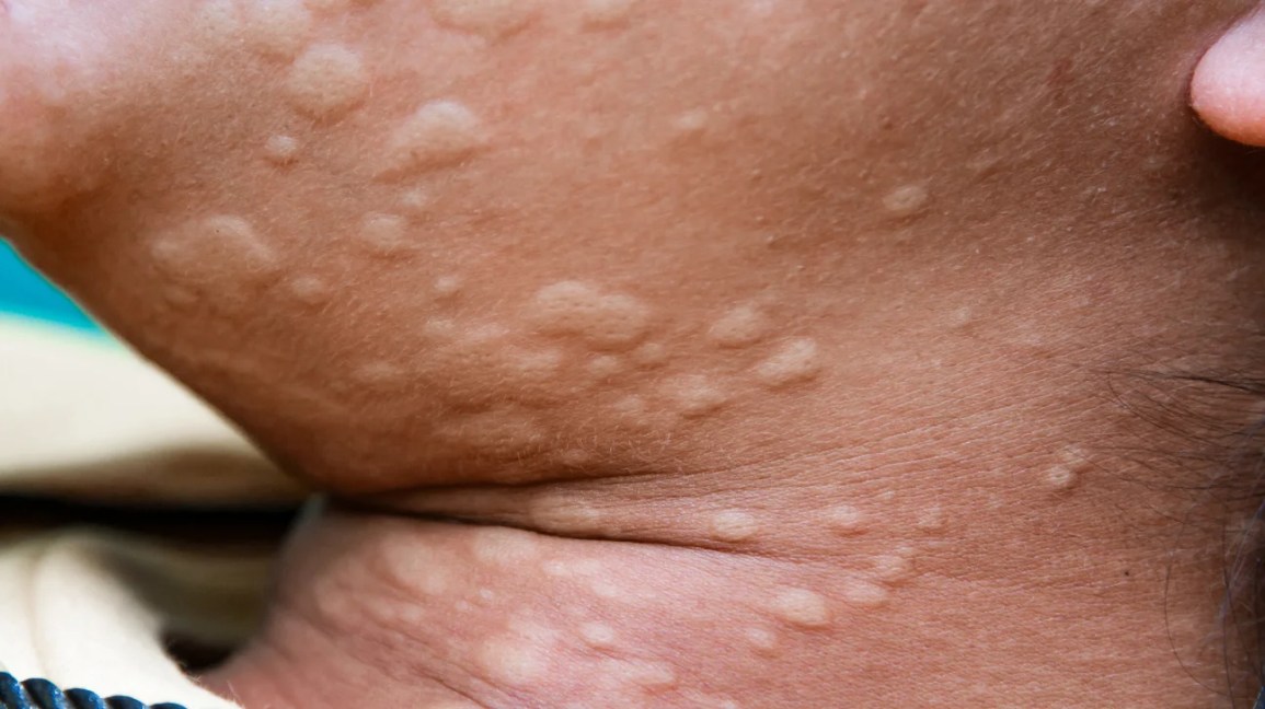 Supot Supot Treatment: Fast Relief for Stubborn Hives