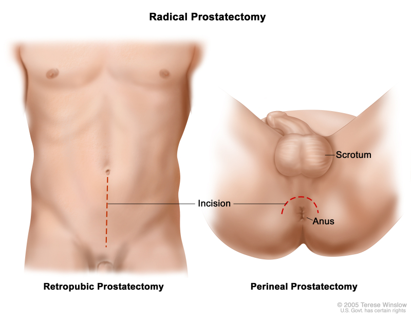 Suprapubic Prostatectomy Incision: What to Expect