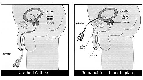 Suprapubic Prostatectomy Procedure: What You Need