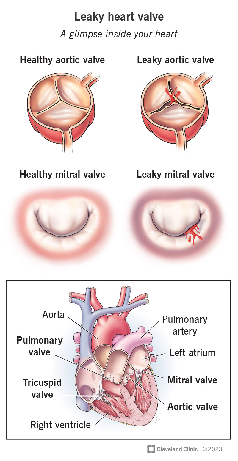 Symptoms of a Leaking Heart Valve and When to Act