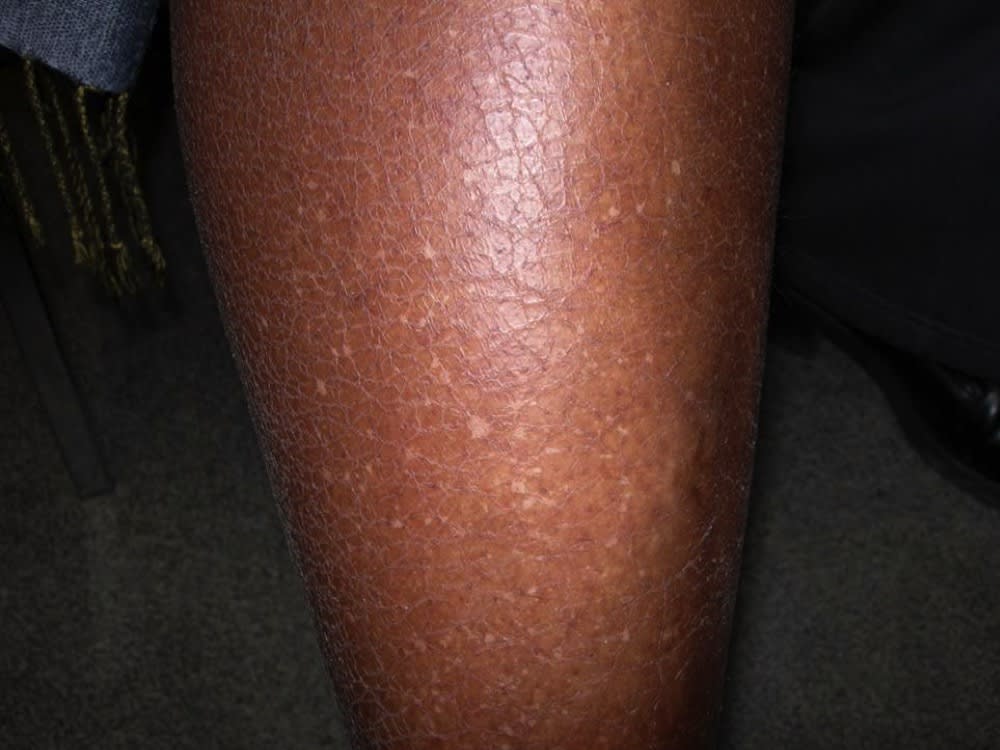 Tiny White Spots on Legs – Their Meaning & Treatment