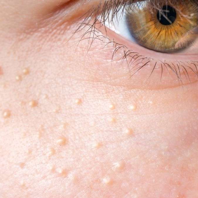 Tiny White Spots on Skin: Causes and Easy Treatments