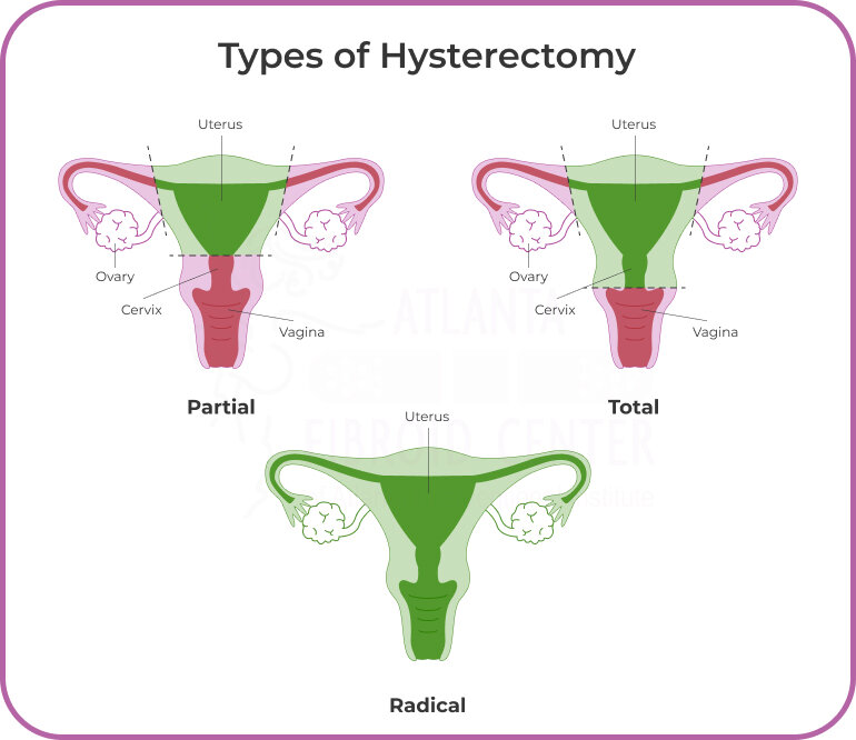 Total Hysterectomy: What It Is and What to Expect