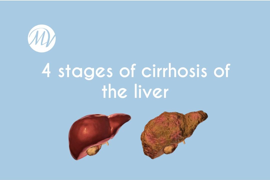 What Are the 4 Stages of Cirrhosis of the Liver?