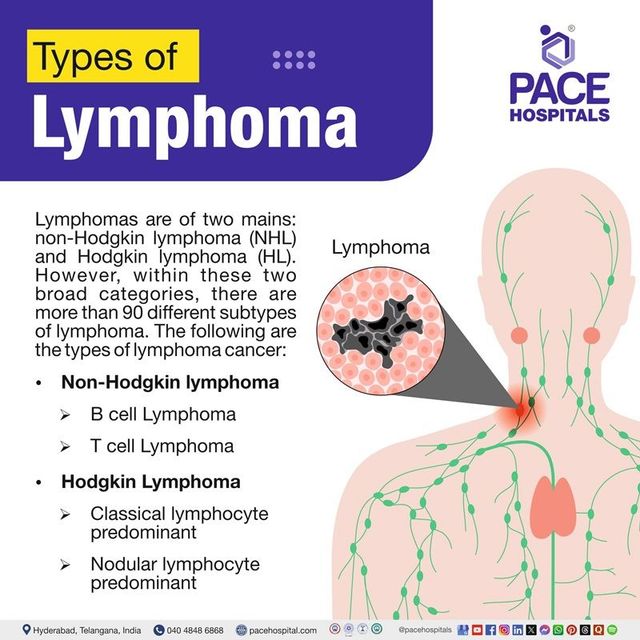 What Are the 4 Types of Lymphoma? Quick Guide