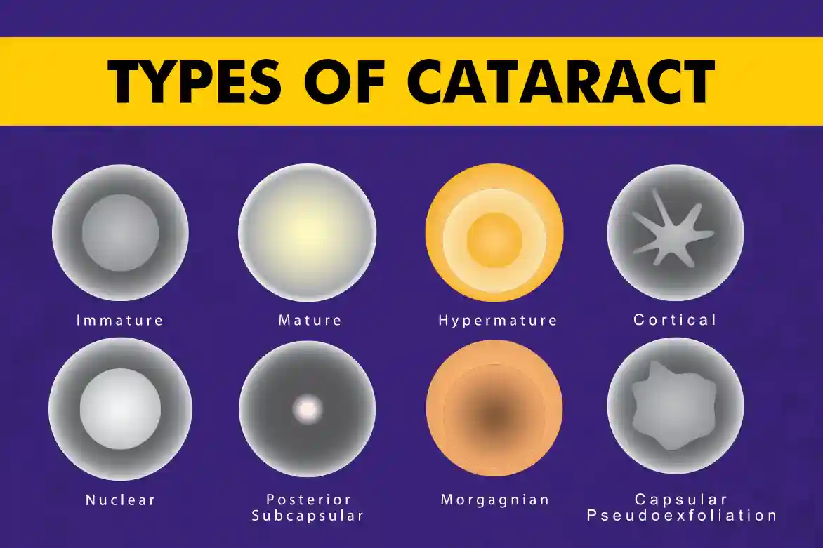 What Are the 5 Types of Cataract? Simple Answers