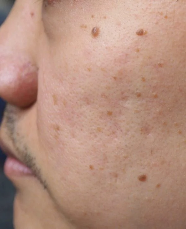 What Causes Moles to Suddenly Appear on Your Face?
