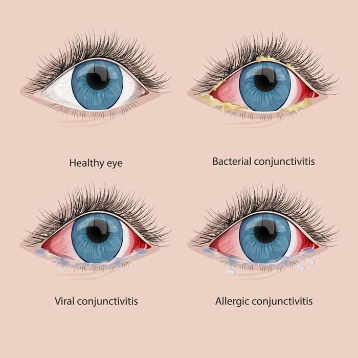 What Causes Pink Eye in Adults? Simple Answers