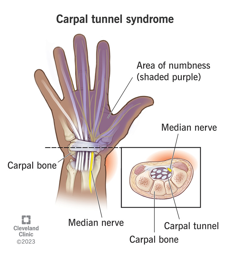 What Irritates Carpal Tunnel? Triggers, Risks & Relief