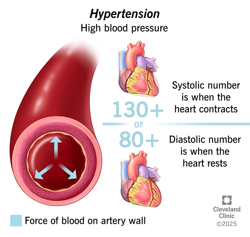 What Is the Main Cause of High Blood Pressure?