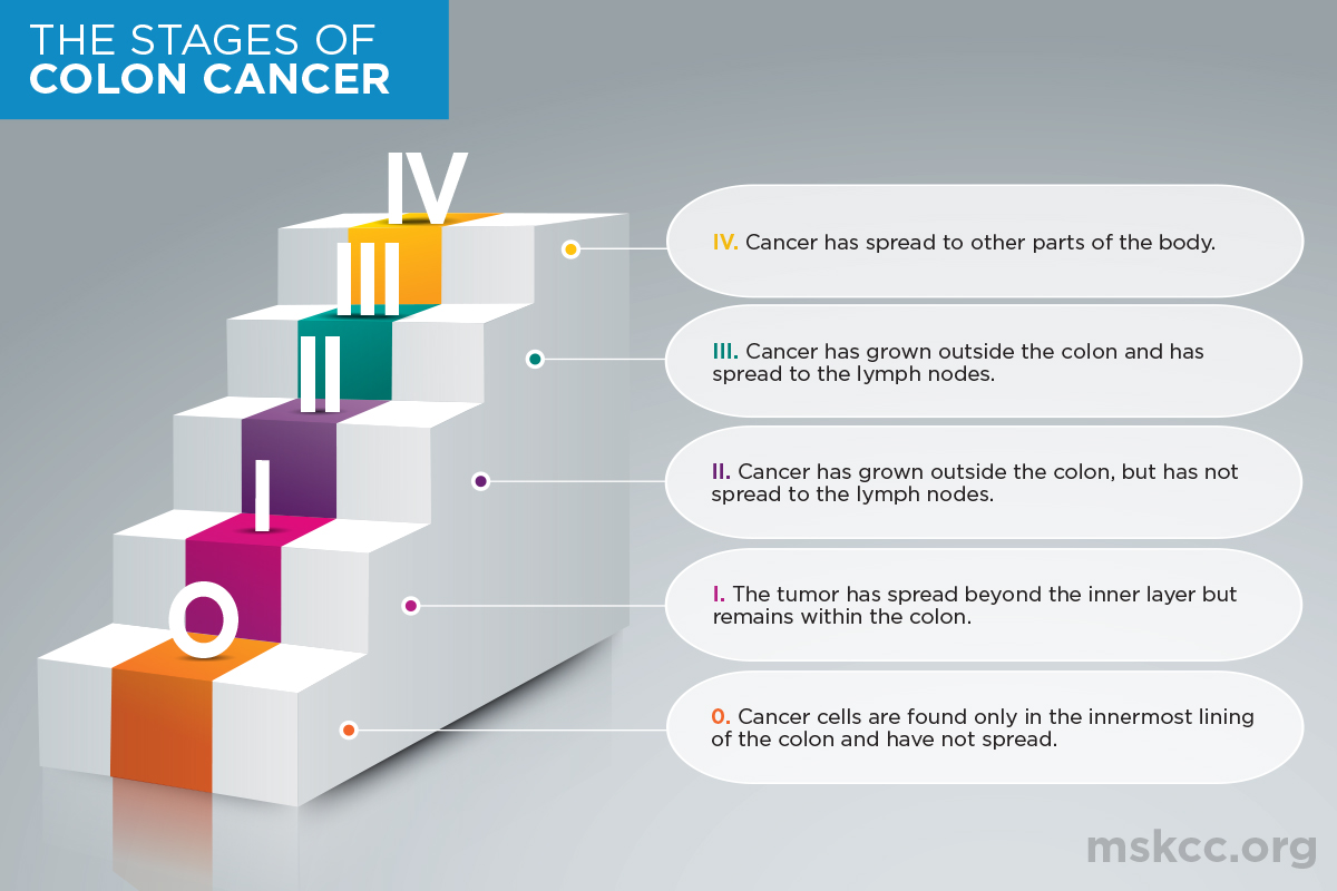What Stage Is a 7 cm Colon Tumor? Quick Friendly Guide