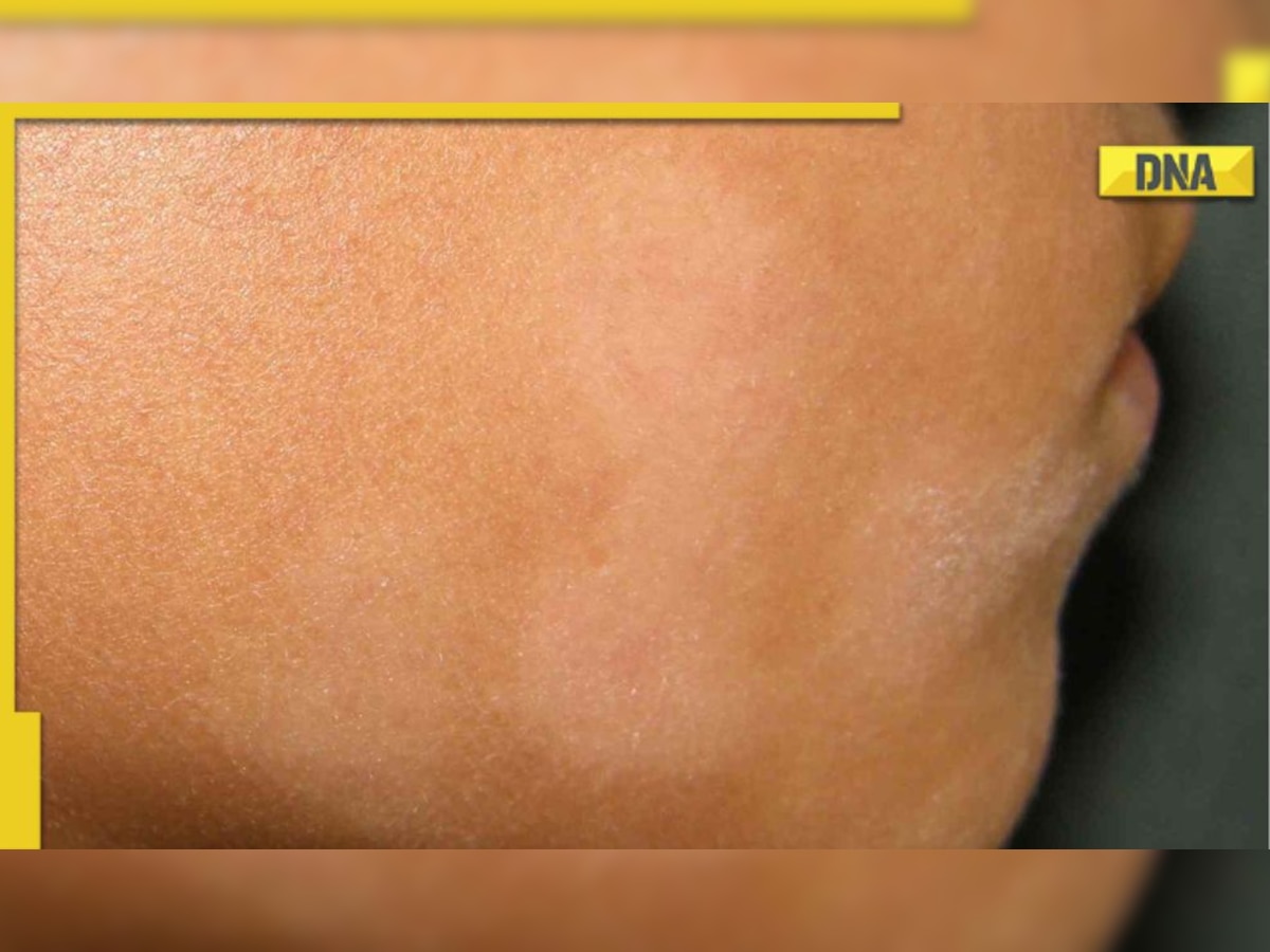 White Patches on Face: Is It a Vitamin Deficiency?