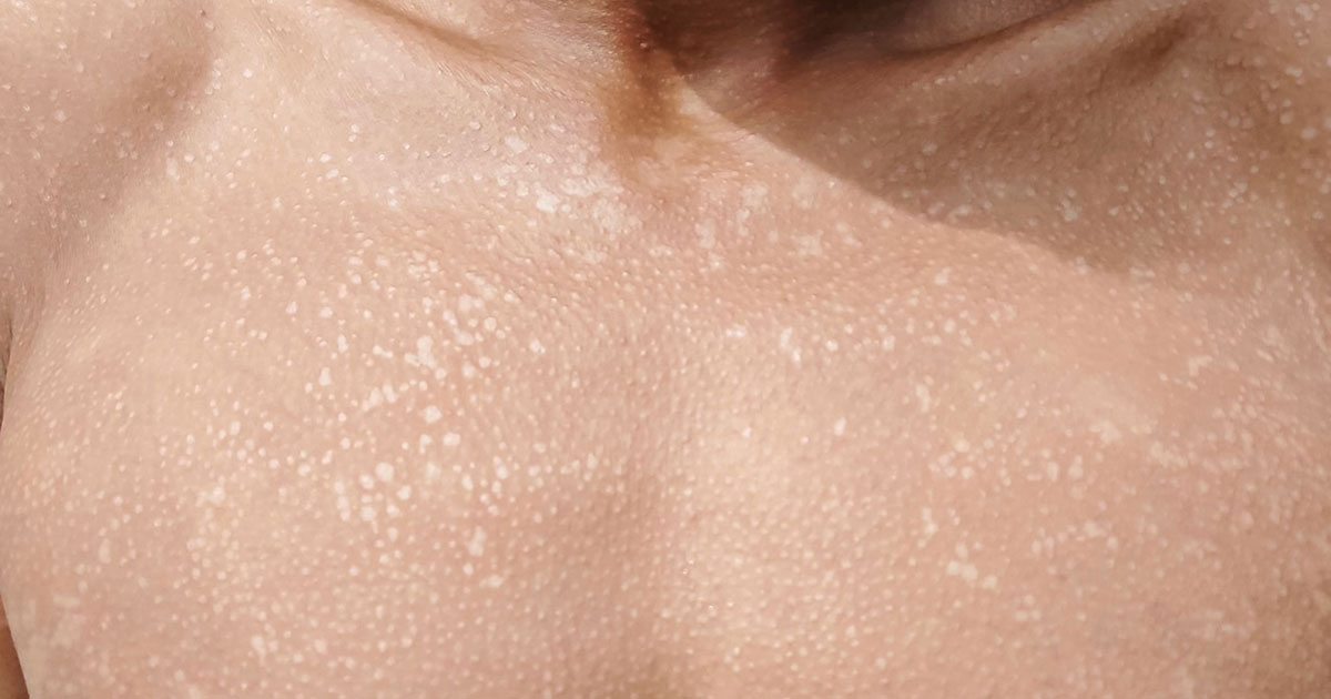 White patches on skin treatment: fast, safe fixes