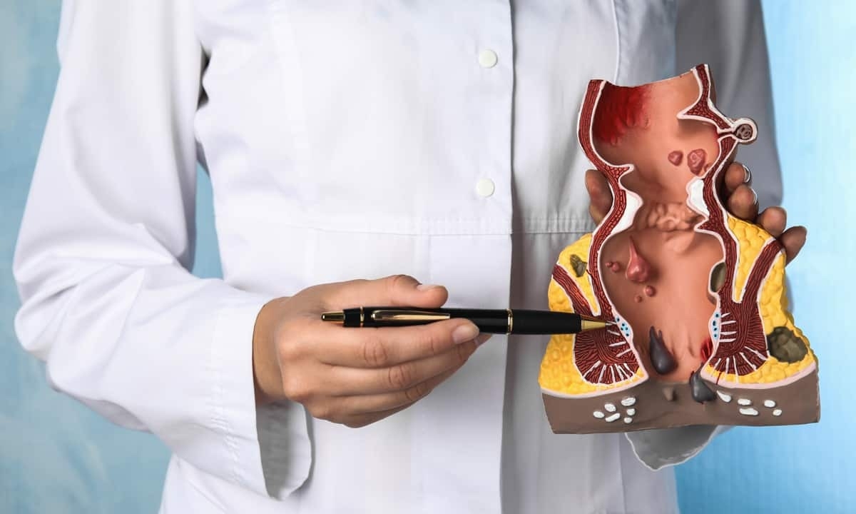 Why Do Hemorrhoids Itch After Pooping? Causes & Relief