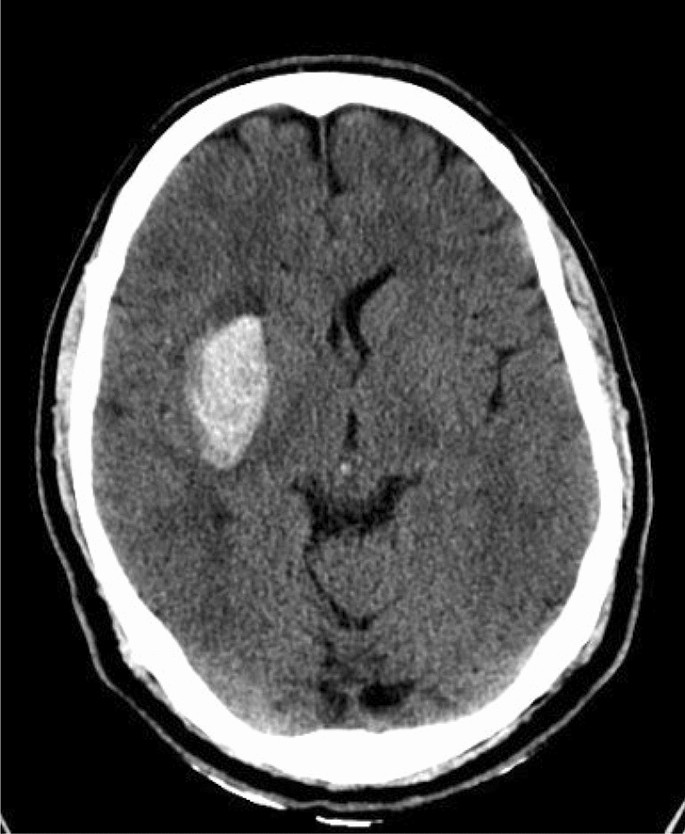 Why No Contrast CT for Stroke? Quick Answers Inside