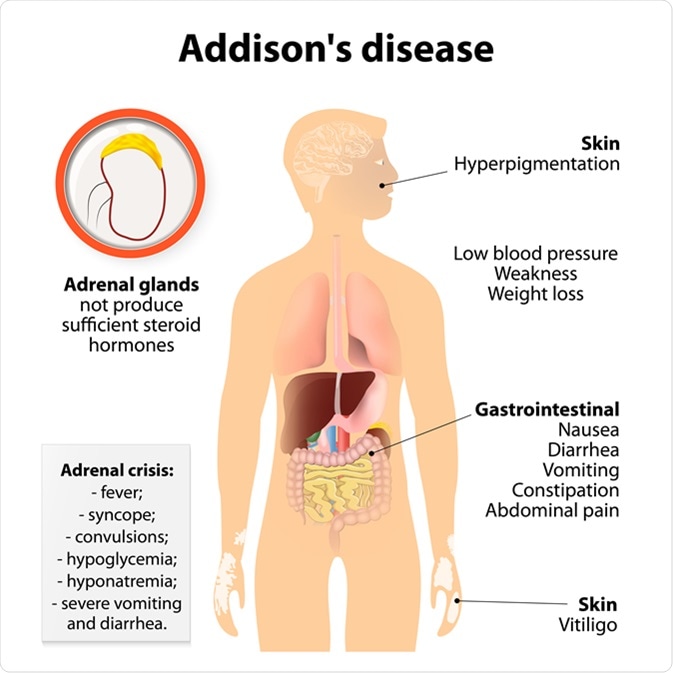 Addison’s Disease: Symptoms, Causes & Treatments