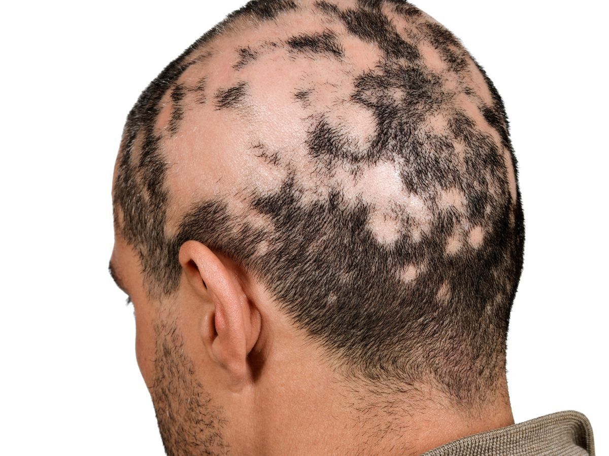 Alopecia Areata Treatment: Real Solutions, Risks & Hope