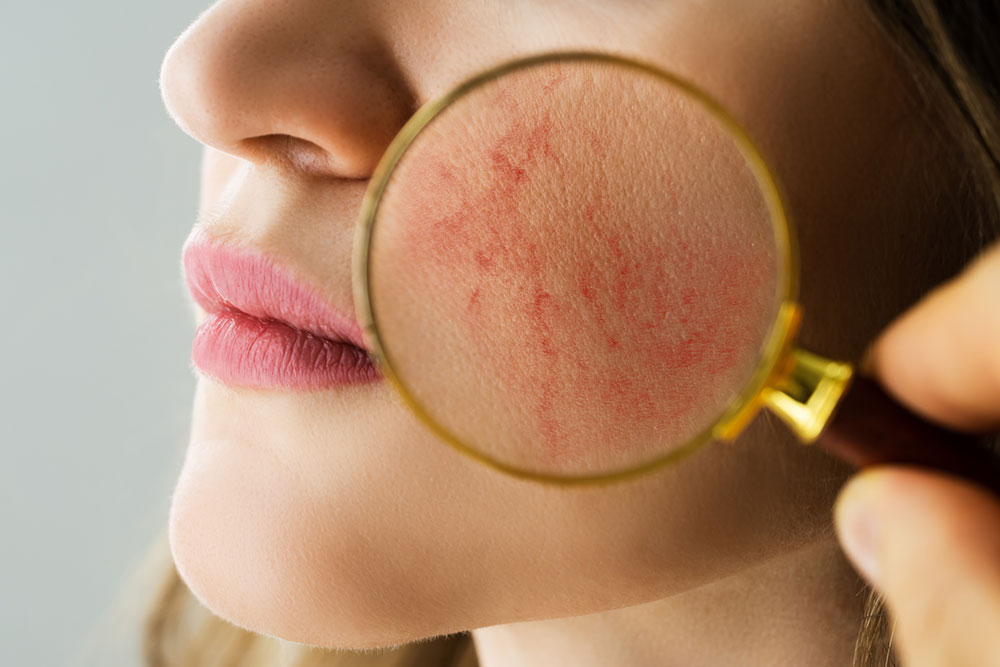 Are rosacea and vitiligo related? The truth you need